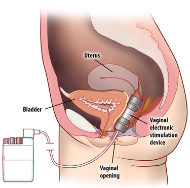 Incontinence, How Quickly Results Come from KWELL EM1 and Other EMS devices?